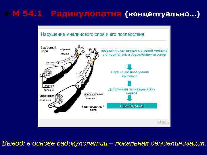 u М 54. 1 Радикулопатия (концептуально…) Вывод: в основе радикулопатии – локальная демиелинизация. 