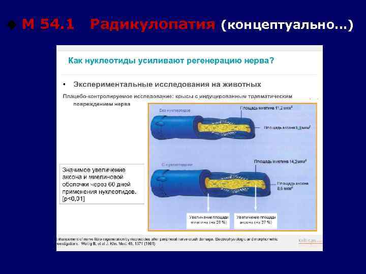 u М 54. 1 Радикулопатия (концептуально…) 
