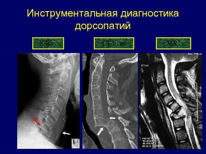 Дорсопатия шейного отдела позвоночника. Классификация дорсопатий. Дорсопатии классификация. Дорсопатия шейного отдела позвоночника симптомы.