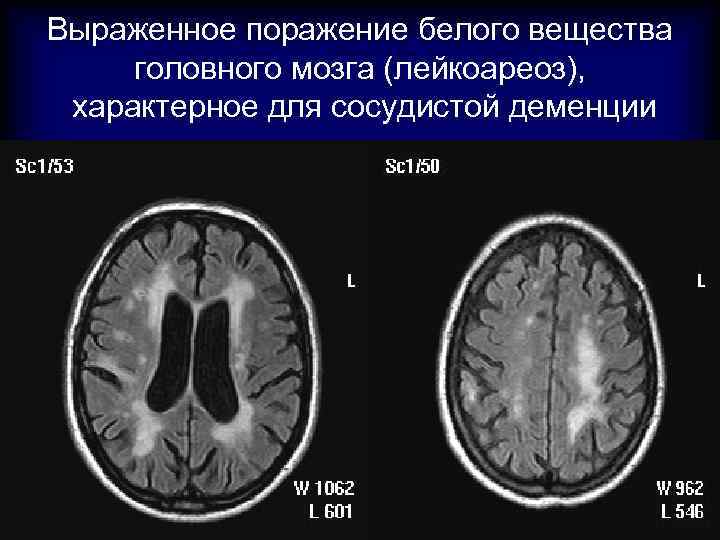 Выраженное поражение белого вещества головного мозга (лейкоареоз), характерное для сосудистой деменции 