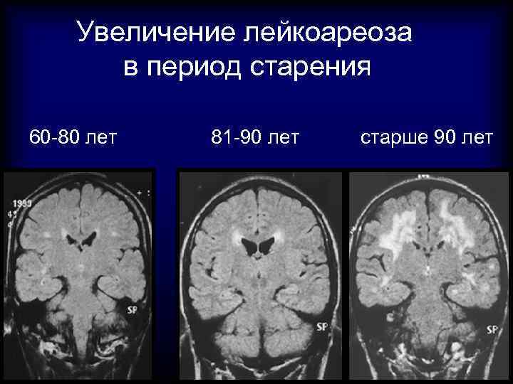 Ишемия головного мозга стадии. Хроническая ишемия мозга мрт. Хроническая ишемия головного мозга на кт и мрт. Лейкоареоз головного мозга на кт.