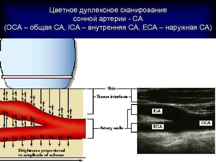 Цветное дуплексное сканирование сонной артерии - СА (OCA – общая СА, ICA – внутренняя