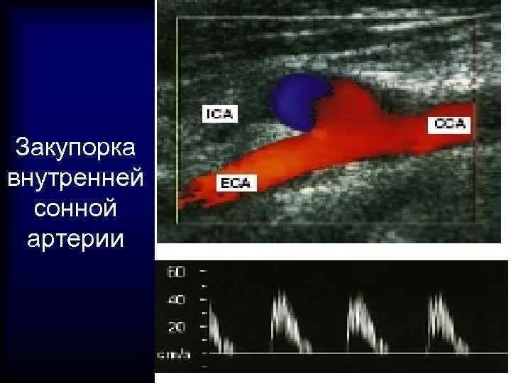 Закупорка внутренней сонной артерии 