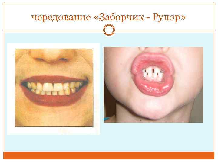 чередование «Заборчик - Рупор» 