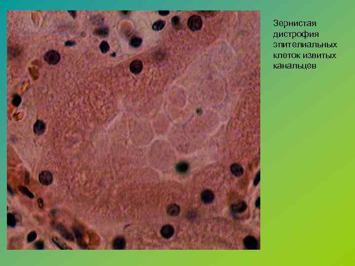 Зернистая дистрофия эпителиальных клеток извитых канальцев 