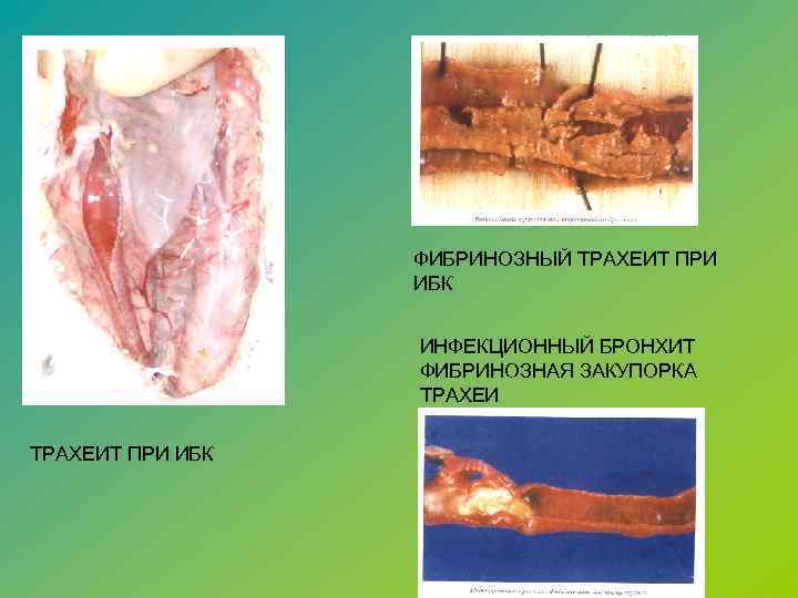 ФИБРИНОЗНЫЙ ТРАХЕИТ ПРИ ИБК ИНФЕКЦИОННЫЙ БРОНХИТ ФИБРИНОЗНАЯ ЗАКУПОРКА ТРАХЕИТ ПРИ ИБК 