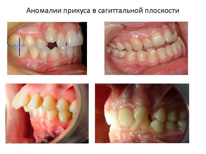 Аномалии прикуса в сагиттальной плоскости 