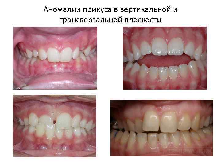 Аномалии прикуса в вертикальной и трансверзальной плоскости 