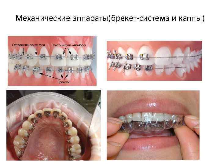 Механические аппараты(брекет-система и каппы) 