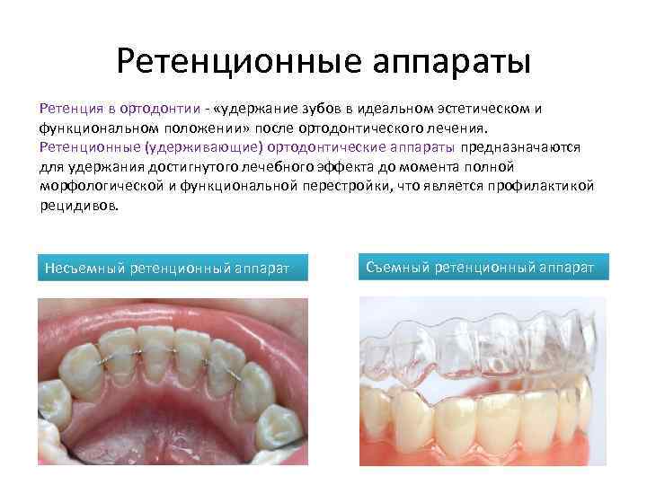 Ретенционные аппараты Ретенция в ортодонтии - «удержание зубов в идеальном эстетическом и функциональном положении»