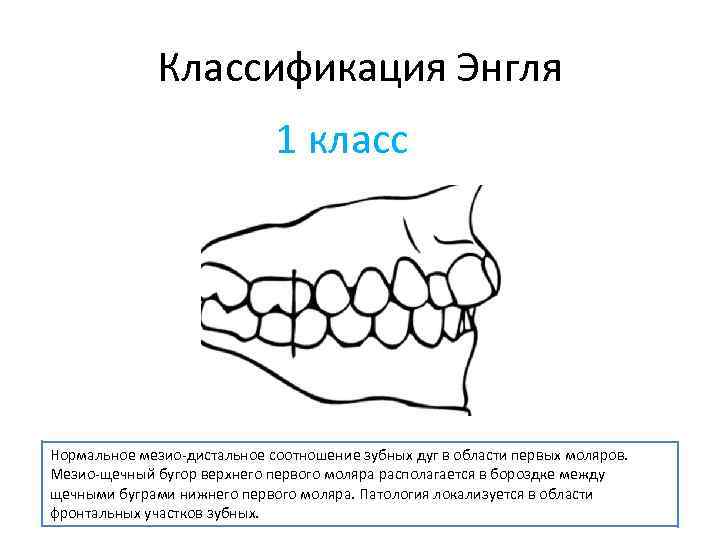 Классификация Энгля 1 класс Нормальное мезио-дистальное соотношение зубных дуг в области первых моляров. Мезио-щечный