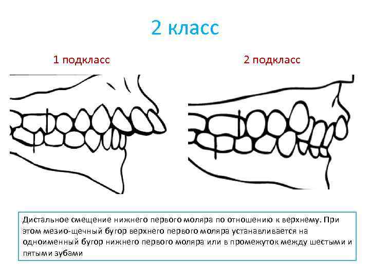 Class 1 class 2. Дистальный прикус 2 подкласс. Классификация аномалий прикуса по Энглю. Классификация Энгля в ортодонтии 1 класс. 2 Класс 2 подкласс Энгля.