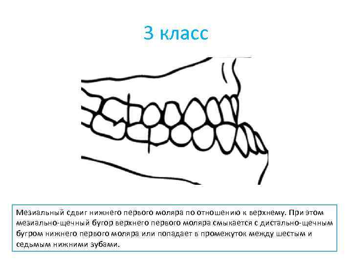 3 класс Мезиальный сдвиг нижнего первого моляра по отношению к верхнему. При этом мезиально-щечный