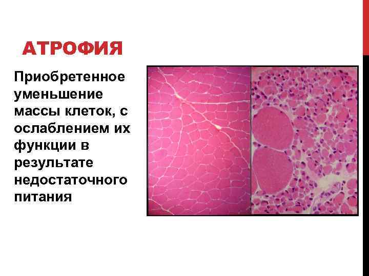 АТРОФИЯ Приобретенное уменьшение массы клеток, с ослаблением их функции в результате недостаточного питания 