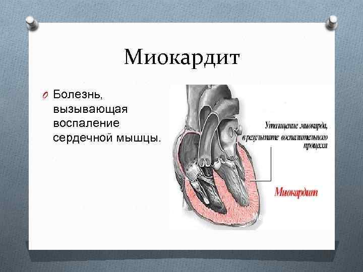 Миокардит O Болезнь, вызывающая воспаление сердечной мышцы. 