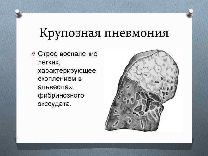 Крупозная пневмония O Строе воспаление легких, характеризующее скоплением в альвеолах фибринозного экссудата. 