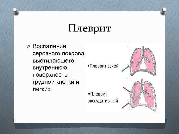 Плеврит O Воспаление серозного покрова, выстилающего внутреннюю поверхность грудной клетки и легких. 