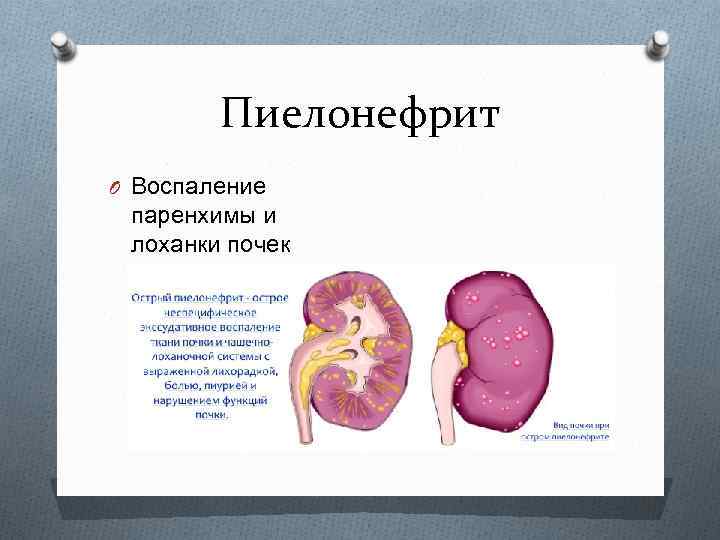 Пиелонефрит O Воспаление паренхимы и лоханки почек 