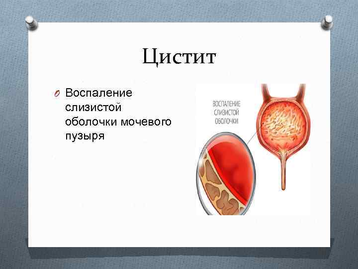 Цистит O Воспаление слизистой оболочки мочевого пузыря 