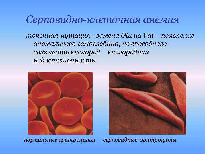 Серповидно-клеточная анемия точечная мутация - замена Glu на Val – появление аномального гемоглобина, не