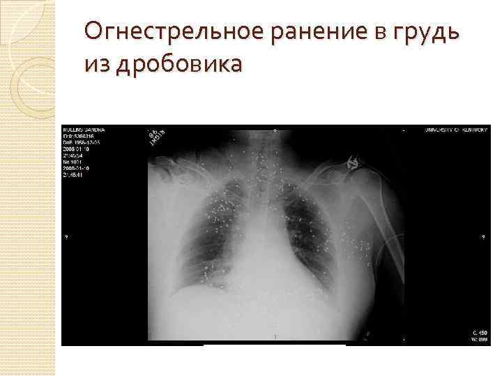 Огнестрельное ранение в грудь из дробовика 