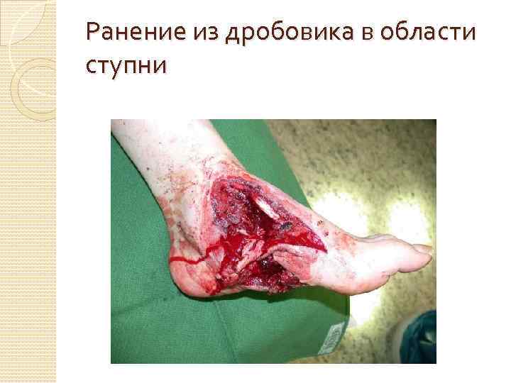 Ранение из дробовика в области ступни 