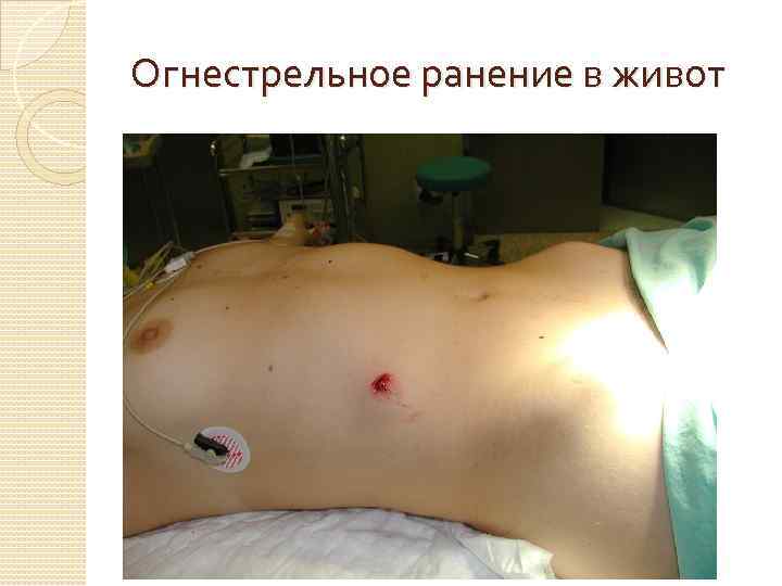 Огнестрельное ранение в живот 