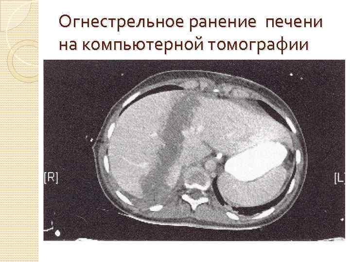 Какие признаки стеатоза печени выявляются при компьютерной томографии