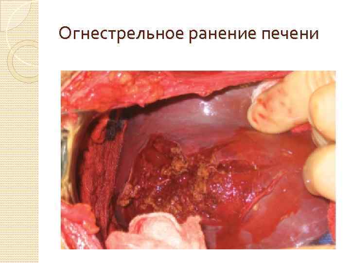 Огнестрельное ранение печени 