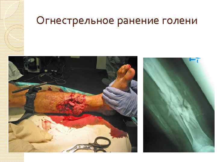 Огнестрельное ранение голени 