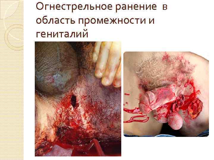 Огнестрельное ранение в область промежности и гениталий 
