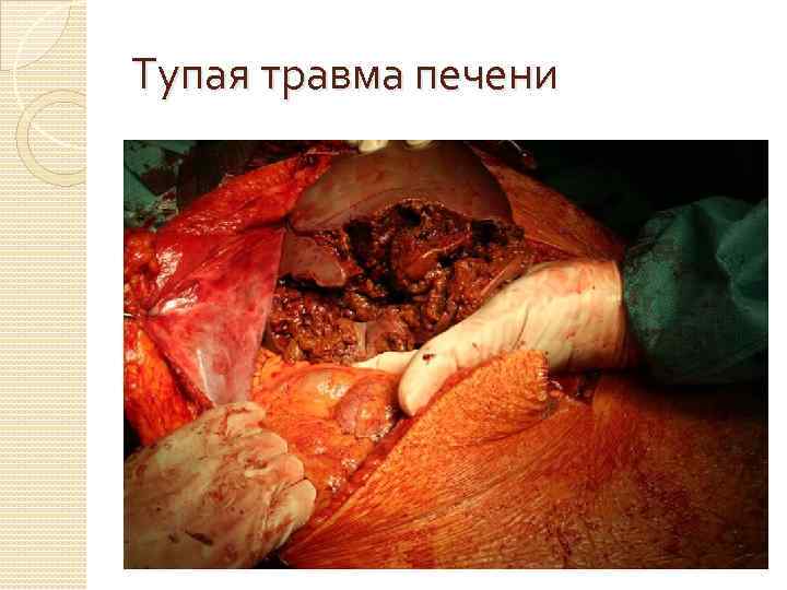 Тупая травма печени 