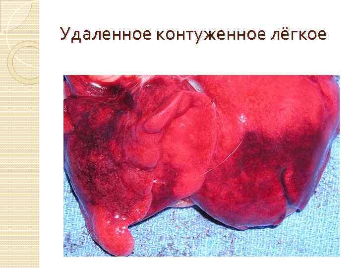 Удаленное контуженное лёгкое 