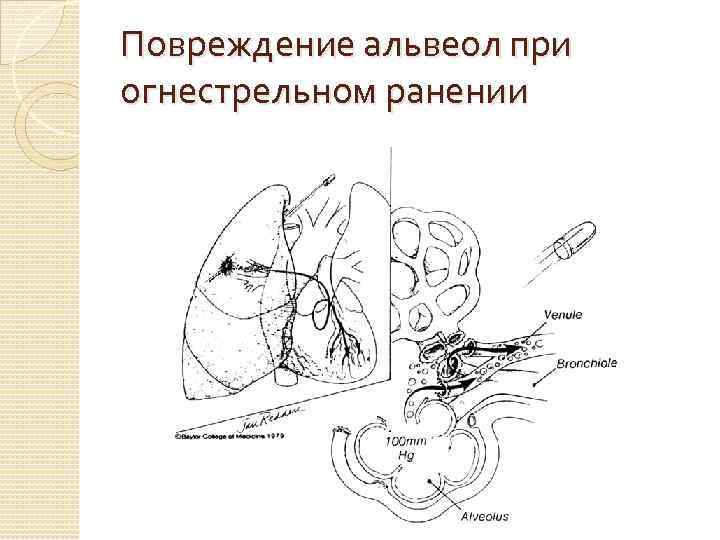 Повреждение альвеол при огнестрельном ранении 