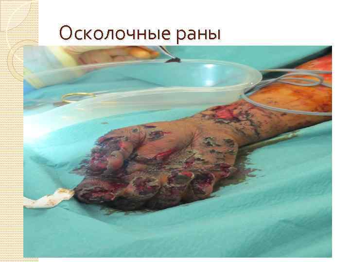 Осколочные раны 