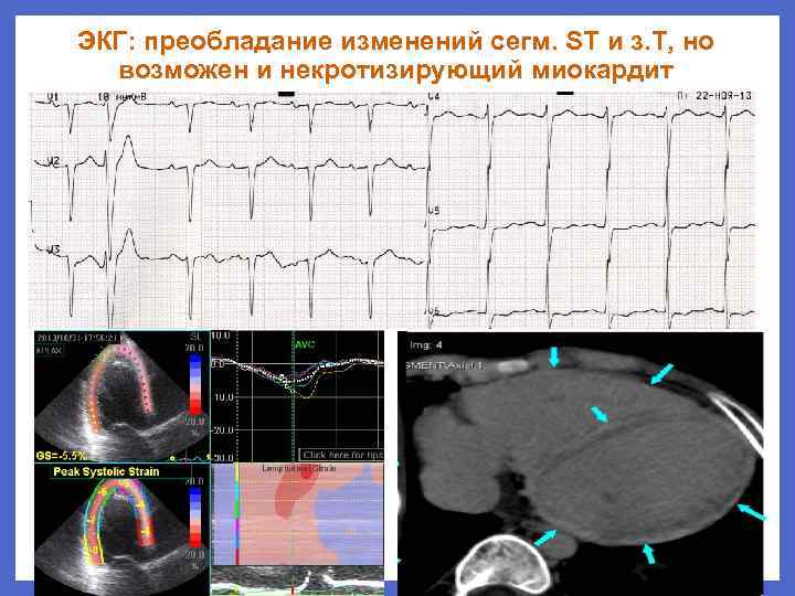 ЭКГ: преобладание изменений сегм. ST и з. T, но возможен и некротизирующий миокардит 