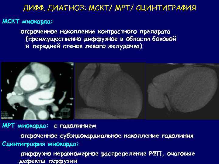 ДИФФ. ДИАГНОЗ: МСКТ/ МРТ/ СЦИНТИГРАФИЯ МСКТ миокарда: отсроченное накопление контрастного препарата (преимущественно диффузное в