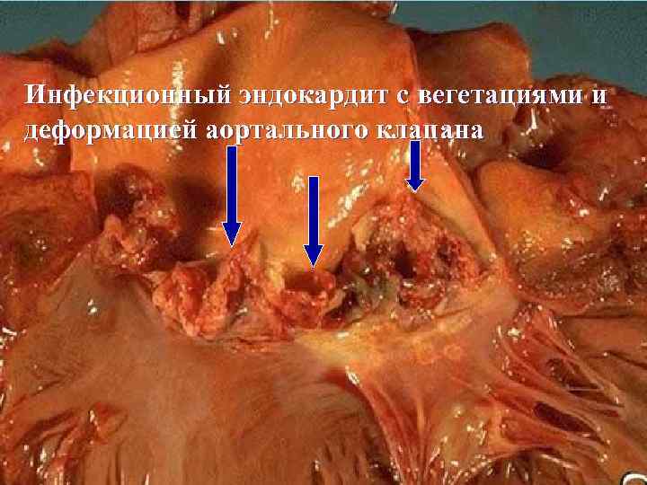 Инфекционный эндокардит с вегетациями и деформацией аортального клапана 