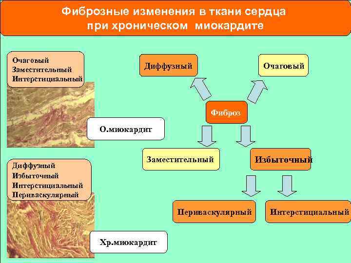 Фиброзные изменения в ткани сердца при хроническом миокардите Очаговый Заместительный Интерстициальный Диффузный Очаговый Фиброз