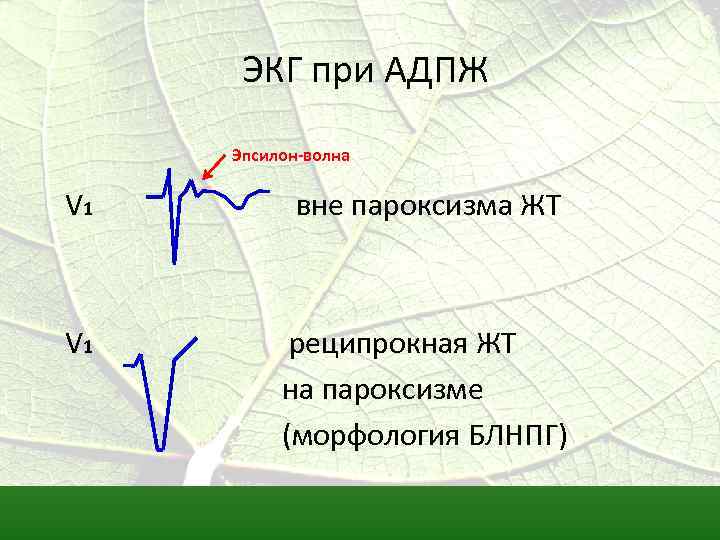 ЭКГ при АДПЖ Эпсилон-волна V 1 вне пароксизма ЖТ V 1 реципрокная ЖТ на