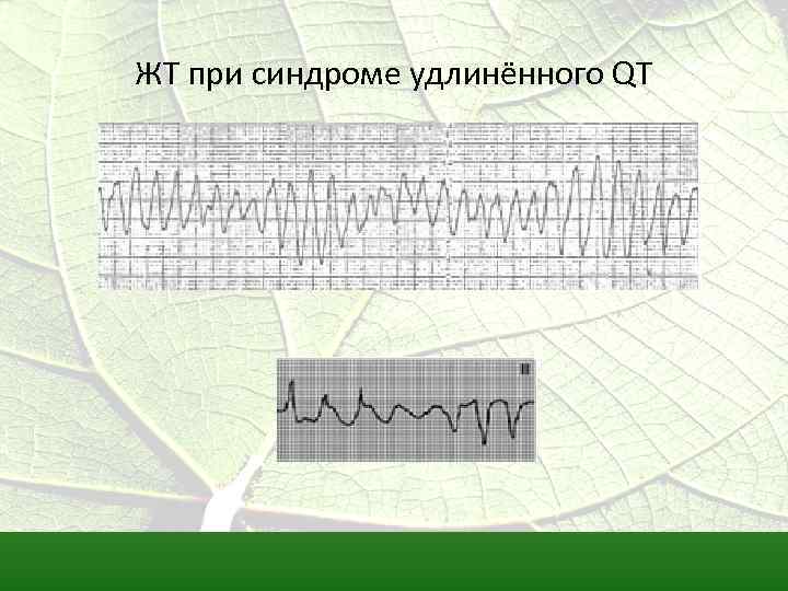 ЖТ при синдроме удлинённого QT 