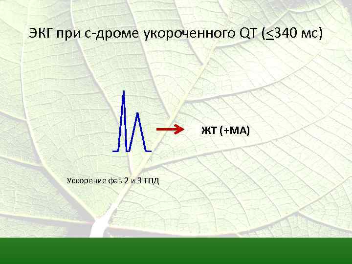 ЭКГ при с-дроме укороченного QT (<340 мс) ЖТ (+МА) Ускорение фаз 2 и 3