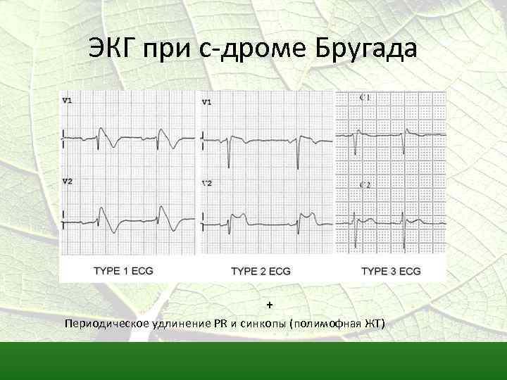 Синдром бругада на экг фото