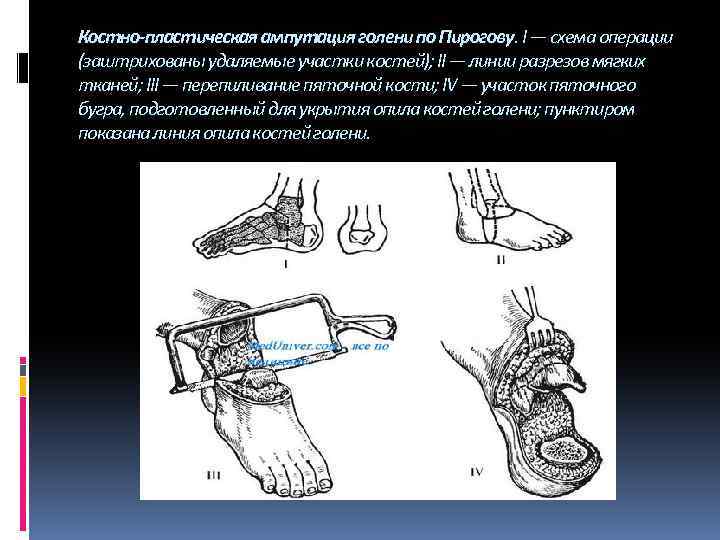 Трехмоментная ампутация