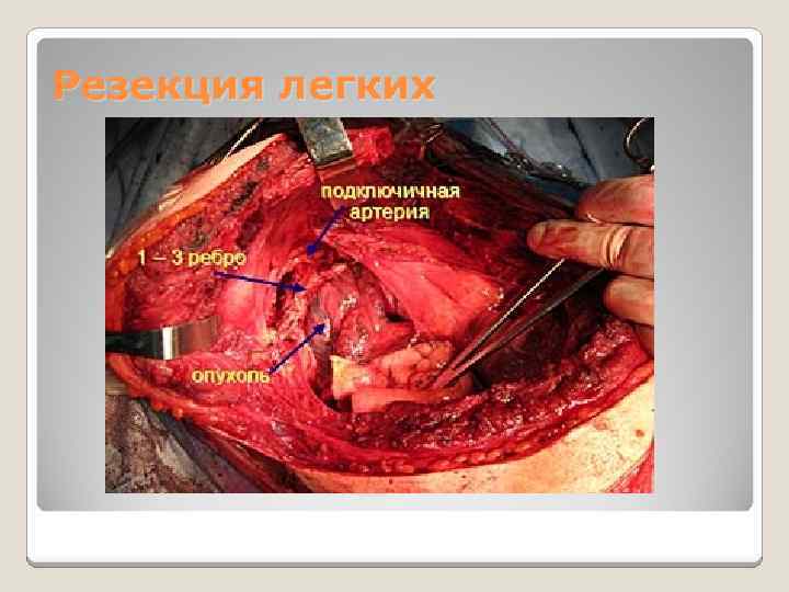 Резекция легких 