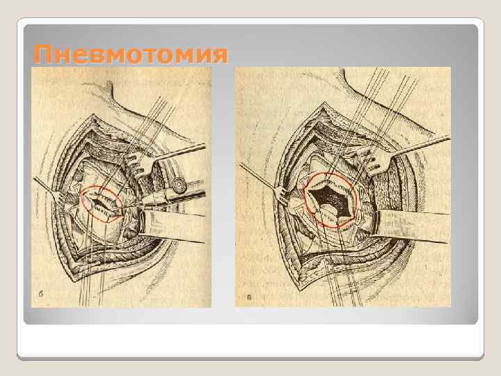 Малые половы губы. Пневмотомия при абсцессе легкого. Двухмоментная пневмотомия при абсцессе легкого. Одномоментная пневмотомия техника.