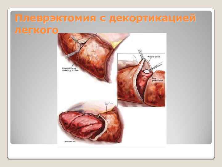 Плеврэктомия с декортикацией легкого 