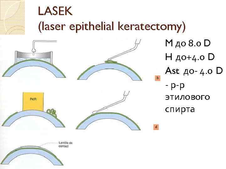 LASEK (laser epithelial keratectomy) M до 8. 0 D H до+4. 0 D Ast