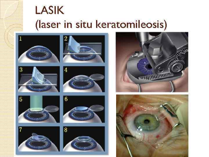 LASIK (laser in situ keratomileosis) 