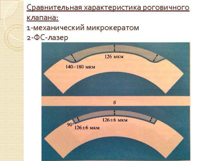 Сравнительная характеристика роговичного клапана: 1 -механический микрокератом 2 -ФС-лазер 